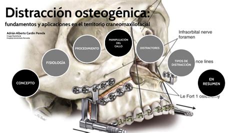 Ilustración o diagrama del proceso de distracción osteogénica mandibular