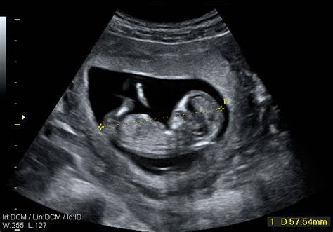 Ecografía 3D de un feto de 12 semanas