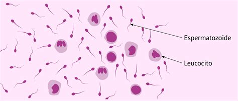 Micrografía de espermatozoides con leucocitos, indicando infección