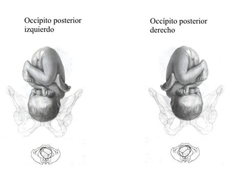Ilustración de un feto en posición occipucio posterior