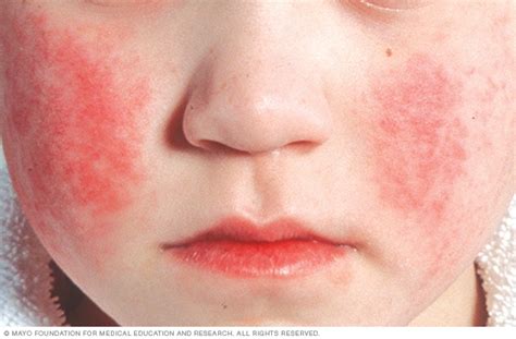 Exantema facial (