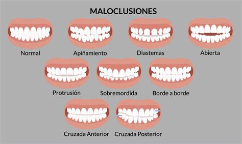 Infografía ilustrando diferentes tipos de maloclusiones dentales