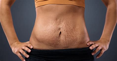 foto de mujer en postparto con vendaje neuromuscular en abdomen
