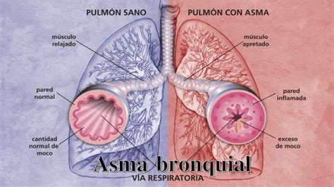 Diagrama de los bronquios afectados por el asma