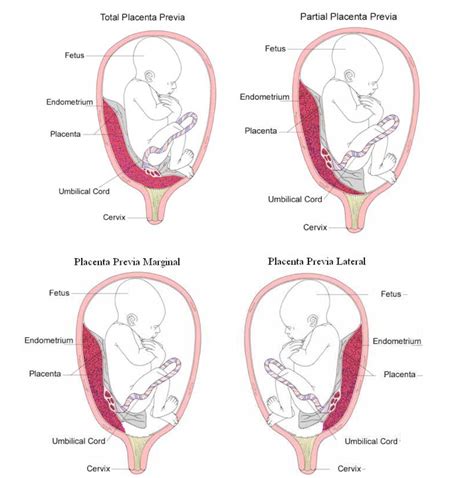 Diagrama de las posiciones de la placenta (anterior, posterior, lateral) en el útero