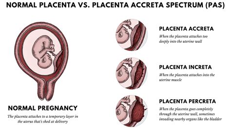 Ilustración de placenta accreta, increta y percreta