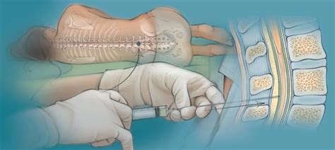 Infografía: proceso de punción lumbar en neonatos