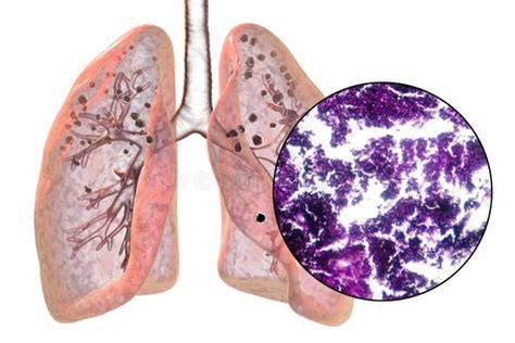 micrografía de pulmones afectados por alquitrán