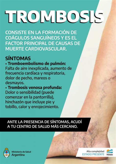 Infografía sobre los síntomas de la trombosis venosa profunda