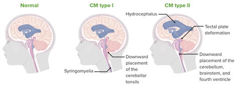 Esquema ilustrativo de los diferentes tipos de Malformación de Chiari (Tipo 0, I, II, III, IV) comparados con un cerebro normal.