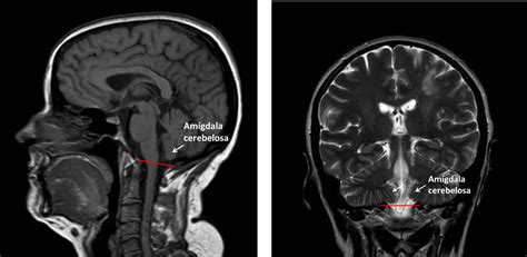 Resonancia Magnética sagital mostrando una medición del descenso de las amígdalas cerebelosas por debajo del foramen magno.