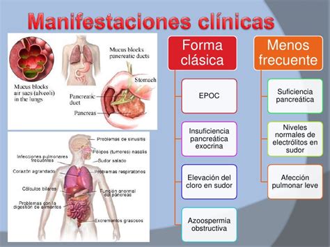 Esquema de las manifestaciones clínicas de la fibrosis quística