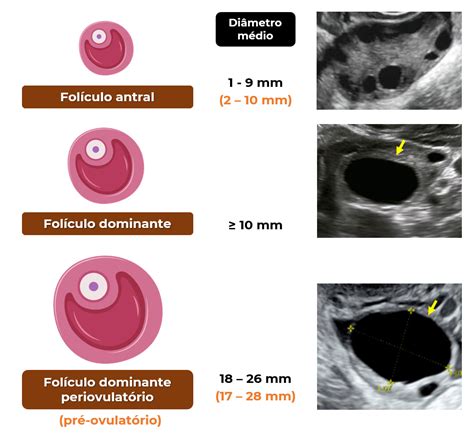 Ecografía transvaginal mostrando folículos ováricos.