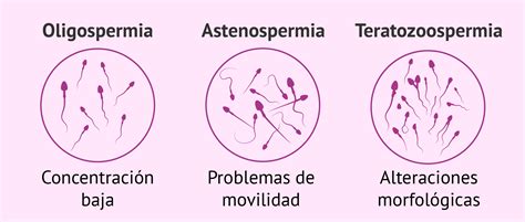Infografía comparativa de las diferentes alteraciones de los espermatozoides (oligozoospermia, astenozoospermia, teratozoospermia) y su impacto en la fertilidad.