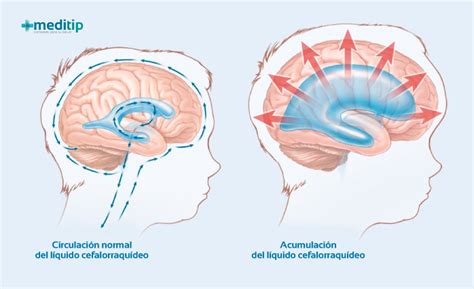 Ilustración de las diferentes causas de la hidrocefalia, como obstrucción, sobreproducción o mala absorción