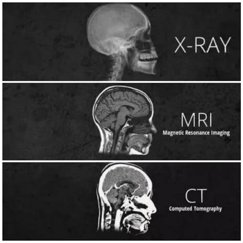 Comparación de imágenes de resonancia magnética (RM) y tomografía computarizada (TC) de un cerebro con hidrocefalia