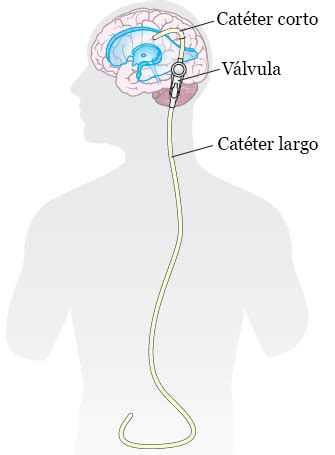 Ilustración de una derivación ventriculoperitoneal (shunt) y su recorrido