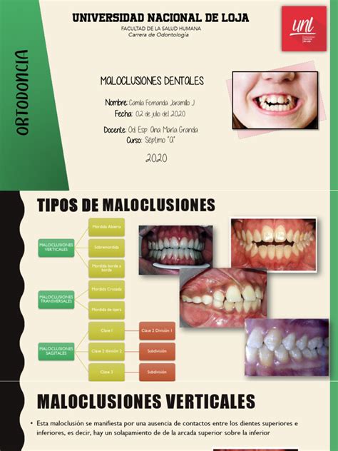 Esquema de las diferentes maloclusiones dentales causadas por el uso del chupete