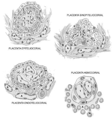 Comparación histológica entre placenta normal y placenta con inmadurez vellositaria en caso de malformación de Chiari II.