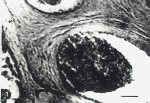Microfotografía de vellosidad placentaria con edema estromal. Los espacios vacíos representan la acumulación de fluido.