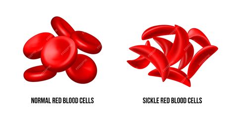 Infografía explicando la diferencia entre glóbulos rojos sanos y células falciformes