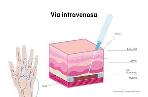 Esquema de un niño recibiendo sedación intravenosa para un procedimiento médico, mostrando la vía en el brazo.