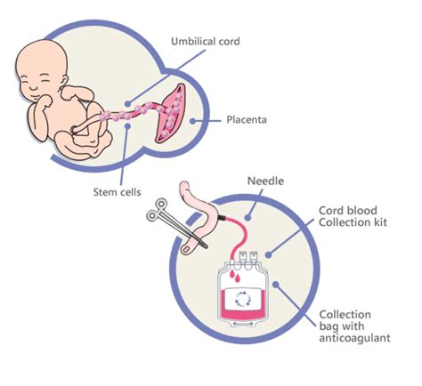 Esquema de la recolección de sangre del cordón umbilical y su procesamiento