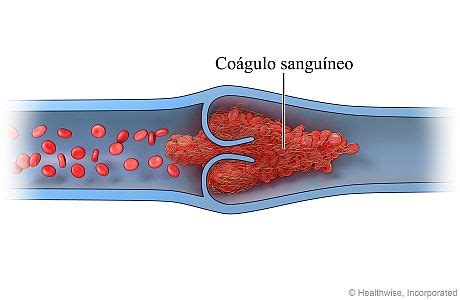 Gráfico ilustrando la formación de un coágulo sanguíneo en una vena