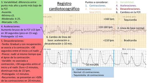 Gráfico de un registro cardiotocográfico mostrando frecuencia cardíaca fetal y contracciones uterinas