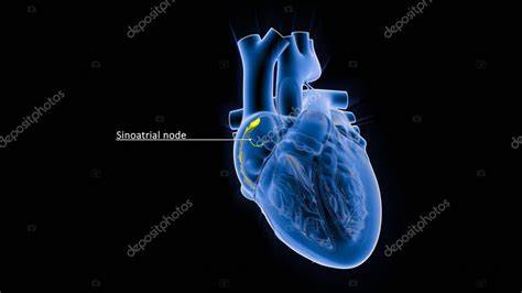 Diagrama del corazón humano mostrando el nódulo sinoauricular y posibles focos ectópicos en aurículas y ventrículos