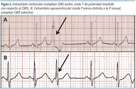 Ejemplo de un trazado de ECG mostrando una extrasístole ventricular