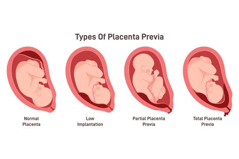 Ilustración comparativa de placenta anterior y placenta previa.