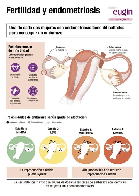 Esquema de las diferentes localizaciones de la endometriosis
