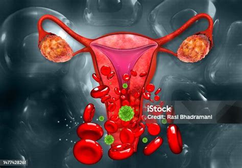 diagrama esquemático del útero mostrando signos de infección y restos de tejido