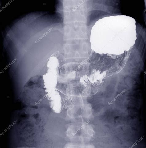 Imagen de un paciente bebiendo el contraste de bario durante una radiografía
