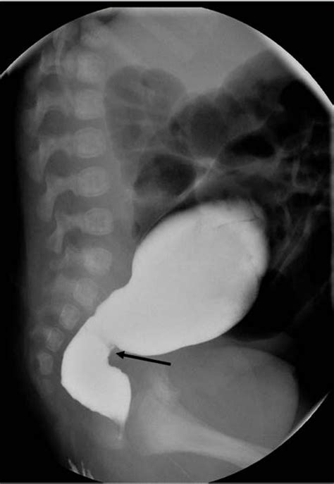 Radiografía de colon mostrando la zona de transición en la Enfermedad de Hirschsprung