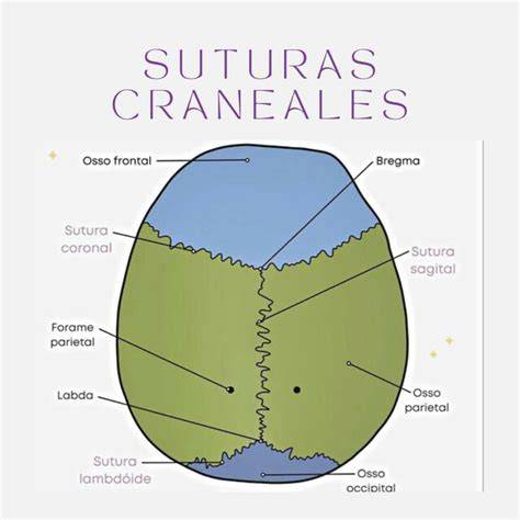 Esquema de las suturas craneales de un bebé y zonas comunes de aplanamiento por plagiocefalia