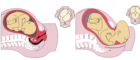 Esquema anatómico mostrando el descenso del feto a través del canal de parto y la dilatación del cuello uterino.