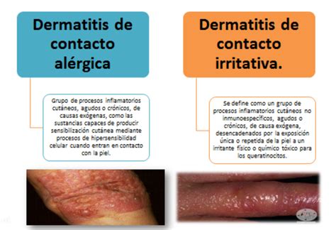 Infografía comparativa: causas de la dermatitis irritativa vs. dermatitis por hongos (candidiasis)