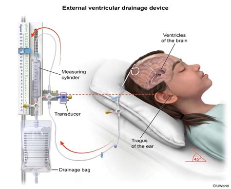 Esquema de un sistema de drenaje ventricular externo (DVE) con sus componentes principales