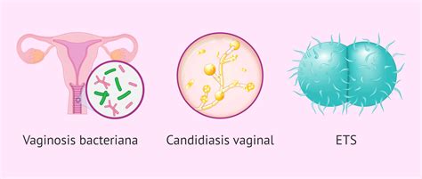 Esquema de las causas de flujo vaginal anormal