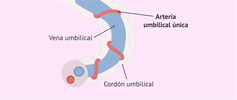 Diagrama del cordón umbilical normal y con arteria umbilical única