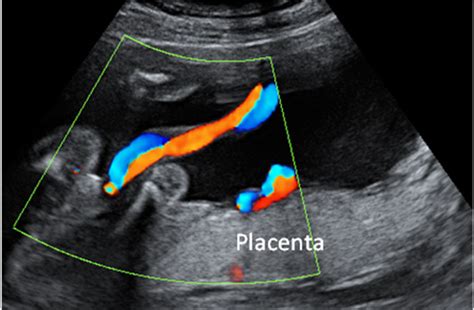 Ecografía Doppler mostrando el cordón umbilical y la vejiga fetal