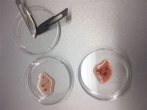 Esquema de punción testicular y biopsia testicular