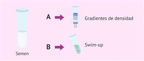 Ilustración de métodos de preparación espermática como gradientes de densidad y swim-up