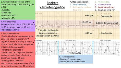 Gráfico de cardiotocografía con patrón de dips