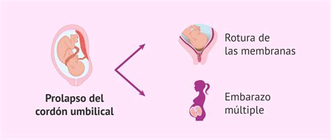 Diagrama que muestra un prolapso del cordón umbilical