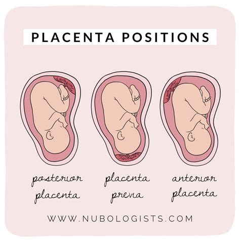 Diagrama de las diferentes posiciones de la placenta en el útero (anterior, posterior, fúndica, lateral) y su relación con el cuello uterino.
