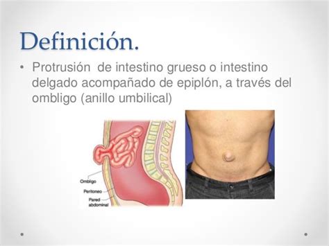 Ilustración de una hernia umbilical mostrando la protrusión del tejido abdominal.