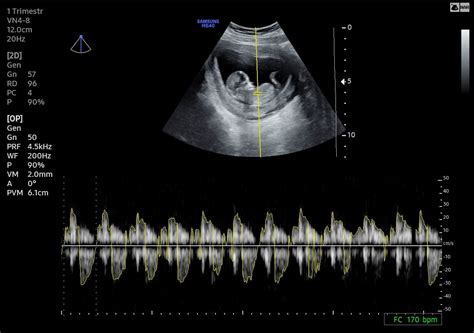 Ecografía de un feto a las 30 semanas de gestación, mostrando su tamaño y posición.